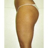 Cellulite cellu m6 après