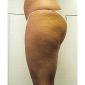 Cellulite cellu m6 avant