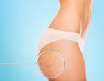 La mésothérapie pour traiter la cellulite