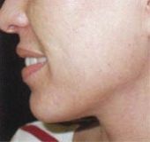 Peeling acné après