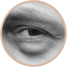 blepharoplastie-sans-chirurgie-avignon